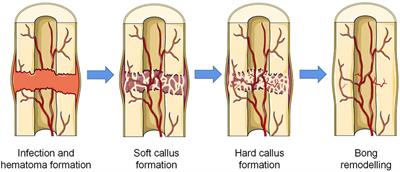 Biomaterial scaffolds regulate macrophage activity to accelerate bone regeneration